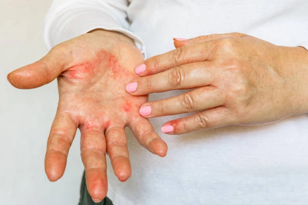 Jarak Bali Untuk Infeksi Kulit