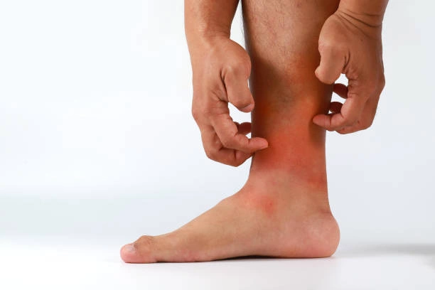 Ginseng Untuk Radang Kulit