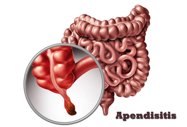 Apendisitis: Gejala, Penyebab dan Cara Pengobatannya