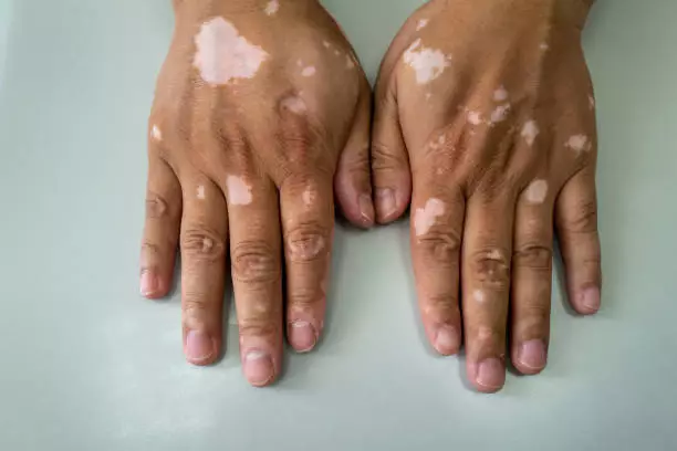 Pengalaman Sembuh Dari Vitiligo Hanya Dengan Minyak Sinergi