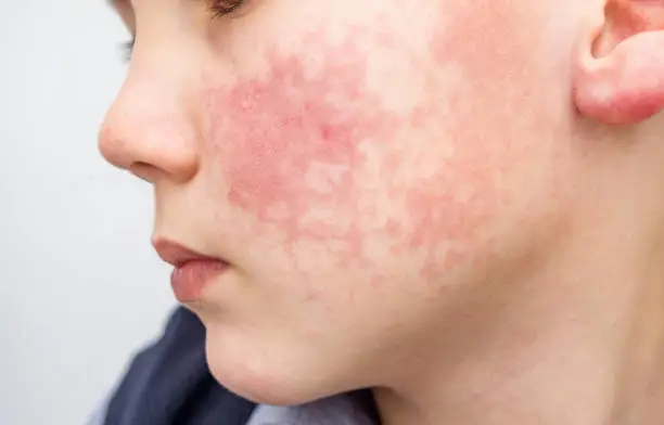 Cara Mengatasi Alergi Dingin Anak Tanpa Kambuh Lagi