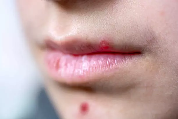 Obat Alami Untuk Bisul di Bibir Pakai PGH Siwak 2 Hari Langsung Kempis