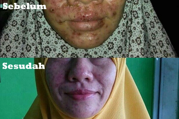 Alergi pada wajah